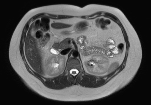 File:Normal liver MRI with Gadolinium (Radiopaedia 58913-66163 Axial T2 16).jpg