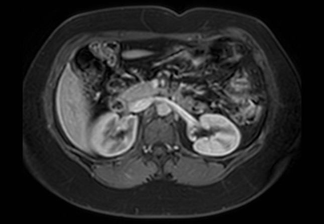 Normal liver MRI with Gadolinium (Radiopaedia 58913-66163 J 28).jpg