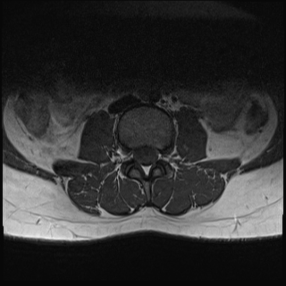 File:Normal lumbar spine MRI- 3 T (Radiopaedia 53280-59250 Axial 10).jpg