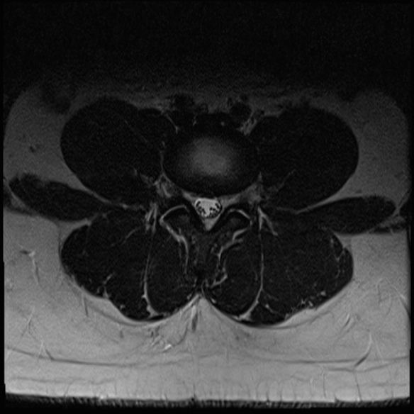 File:Normal lumbar spine MRI (Radiopaedia 47857-52609 Axial T2 16).jpg