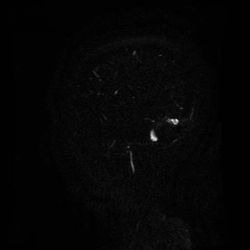 Normal noncontrast MR venography (Radiopaedia 87578-103957 A 148).jpg