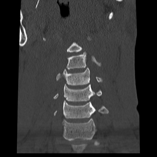 File:Normal trauma cervical spine (Radiopaedia 41017-43760 Coronal bone window 10).png