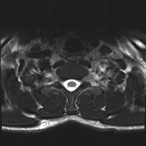 Normal trauma cervical spine (Radiopaedia 41017-43762 D 56).png