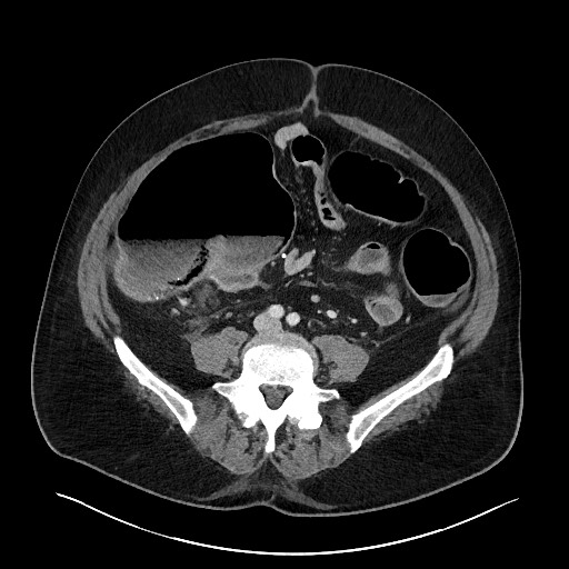 Obstructing sigmoid adenocarcinoma (Radiopaedia 58465-65619 A 108).jpg