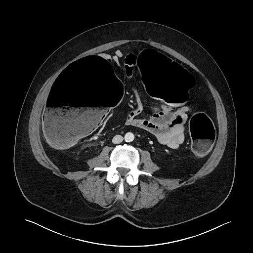 Obstructing sigmoid adenocarcinoma (Radiopaedia 58465-65619 A 96).jpg
