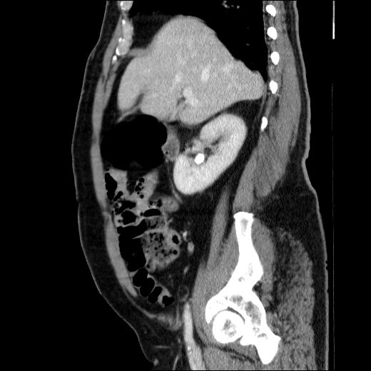 Obstructing ureteric calculus (Radiopaedia 49281-54373 C 63).jpg