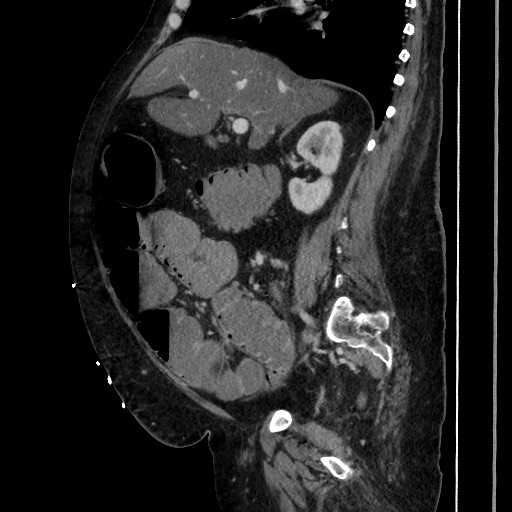 Obstructive colonic diverticular stricture (Radiopaedia 81085-94675 C 102).jpg