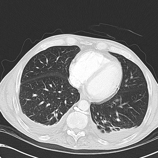 File:Obstructive superior vena cava tumor thrombus (Radiopaedia 28046-28306 Axial lung window 39).jpg