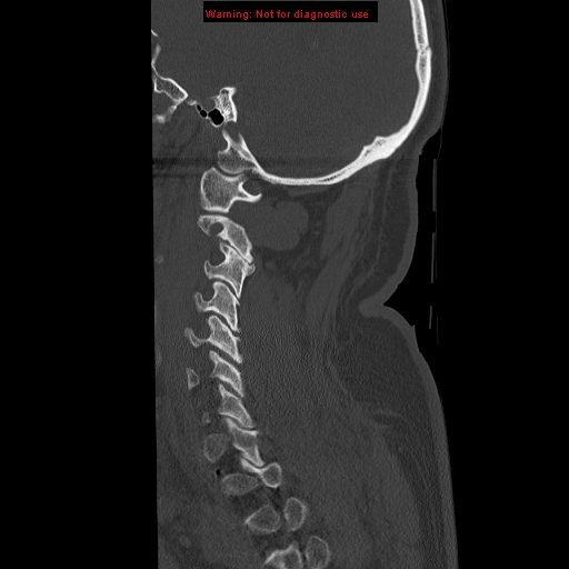File:Occipital condyle fracture (Radiopaedia 18366-18208 Sagittal bone window 8).jpg