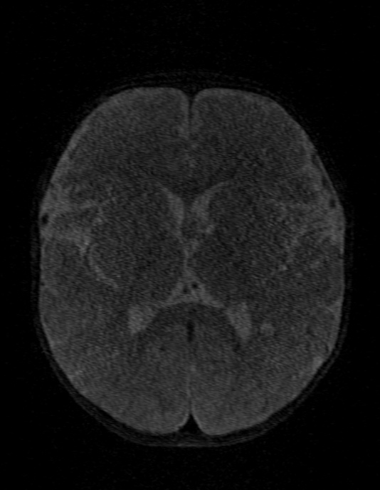 Occipital horn syndrome (Radiopaedia 14255-14129 MRA 90).jpg
