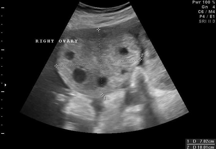 File:Ovarian hyperplasia (Radiopaedia 36247).jpg