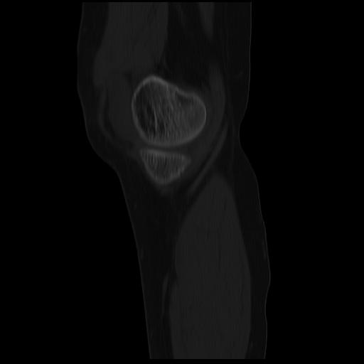 File:ACL avulsion fracture (Radiopaedia 33833-34994 Sagittal bone window 37).jpg