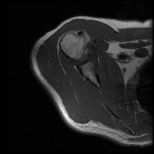 File:ALPSA, SLAP2 tear, and GAGL lesion of shoulder (Radiopaedia 34195-35451 Axial T1 12).jpg