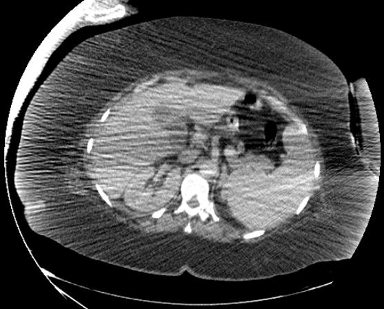 File:Abdominal abscess - pre and post percutaneous drainage (Radiopaedia 60209-67816 Axial 73).png