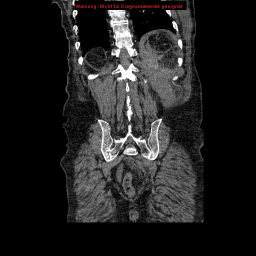 Abdominal aortic aneurysm- extremely large, ruptured (Radiopaedia 19882-19921 Coronal C+ arterial phase 87).jpg