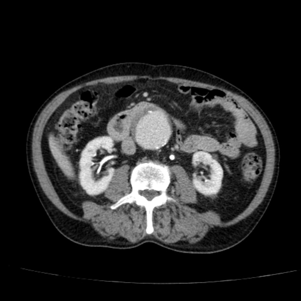 Abdominal aortic aneurysm (Radiopaedia 29248-29660 Axial C+ portal venous phase 30).jpg