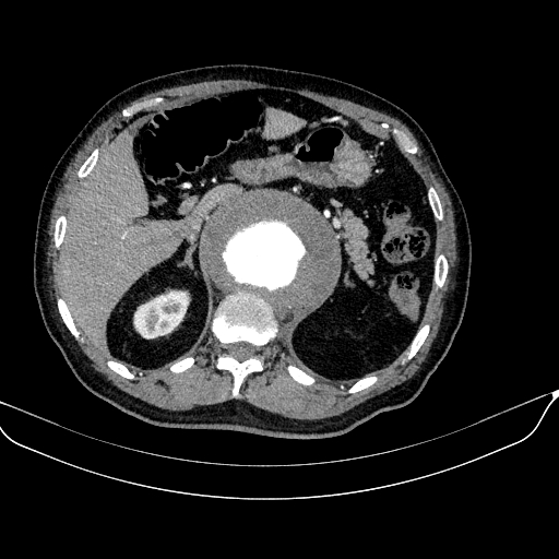 Abdominal aortic aneurysm (Radiopaedia 67117-76452 Axial C+ arterial phase 37).jpg