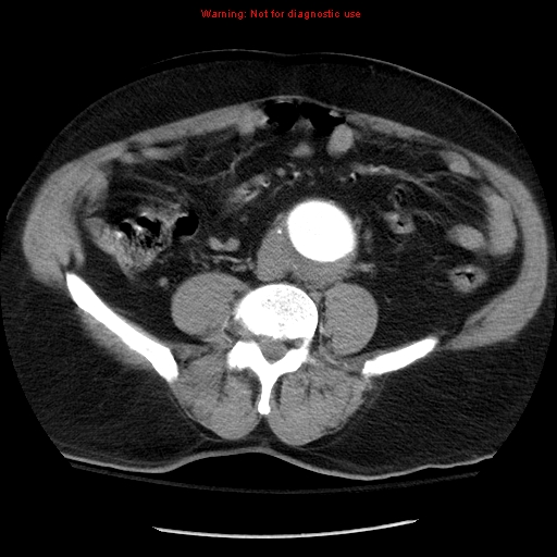 Abdominal aortic aneurysm (Radiopaedia 8190-9038 Axial C+ arterial phase 51).jpg