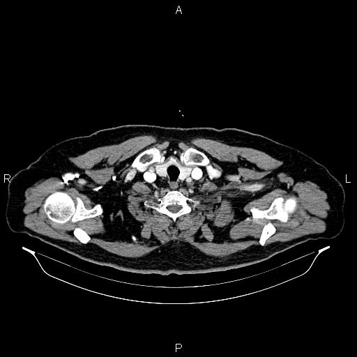 Abdominal aortic aneurysm (Radiopaedia 83094-97462 Axial renal cortical phase 5).jpg