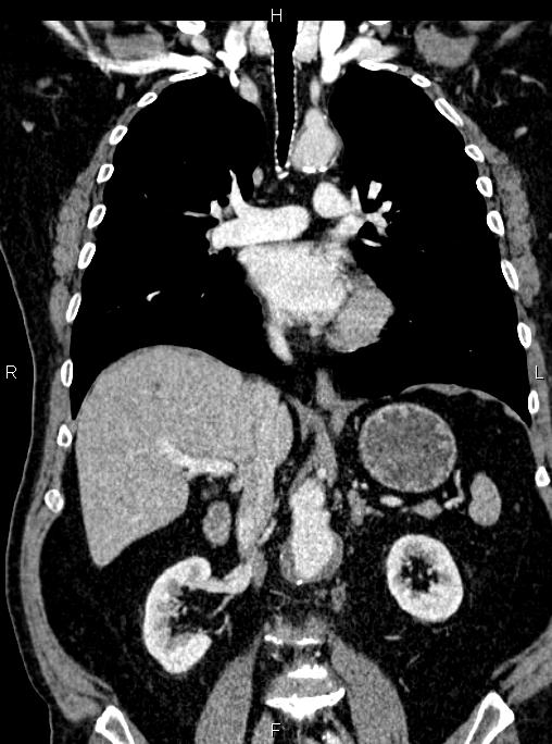 Abdominal aortic aneurysm (Radiopaedia 83094-97462 Coronal renal cortical phase 51).jpg