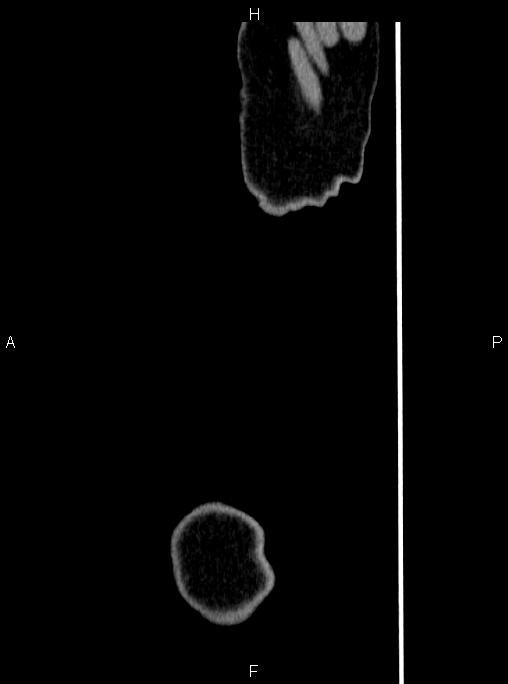 Abdominal aortic aneurysm (Radiopaedia 83094-97462 Sagittal renal cortical phase 132).jpg