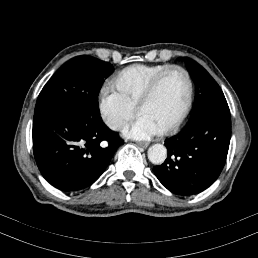 File:Abdominal aortic aneurysm (Radiopaedia 83581-98689 Axial C+ portal venous phase 3).jpg