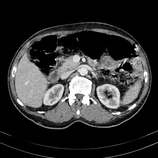 Abdominal aortic aneurysm (Radiopaedia 83581-98689 Axial C+ portal venous phase 42).jpg