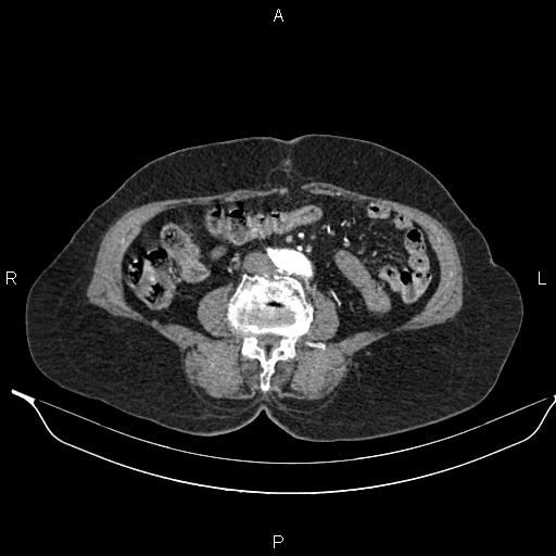 File:Abdominal aortic aneurysm (Radiopaedia 85063-100606 Axial C+ arterial phase 45).jpg