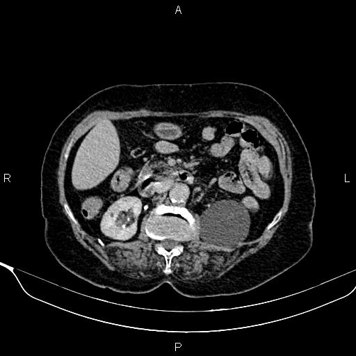 Abdominal aortic aneurysm (Radiopaedia 85063-100606 Axial C+ delayed 43).jpg