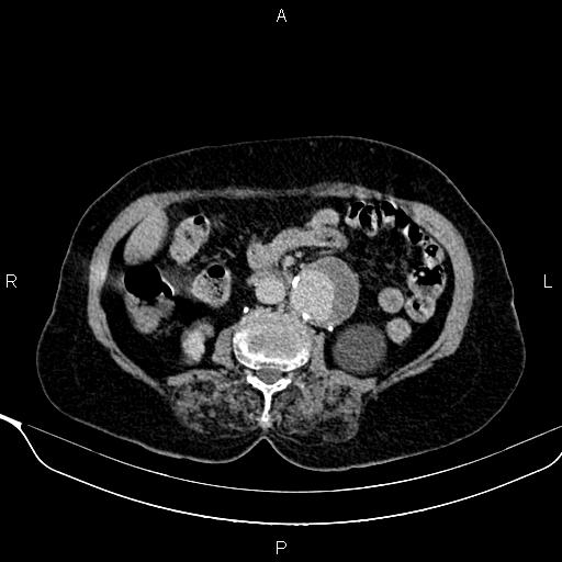 File:Abdominal aortic aneurysm (Radiopaedia 85063-100606 Axial C+ delayed 55).jpg