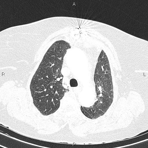Abdominal aortic aneurysm (Radiopaedia 85063-100606 Axial lung window 24).jpg
