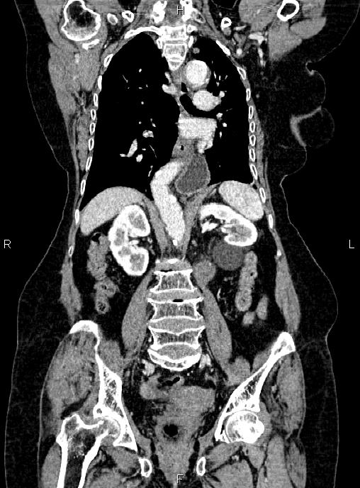 Abdominal aortic aneurysm (Radiopaedia 85063-100606 Coronal C+ arterial phase 35).jpg