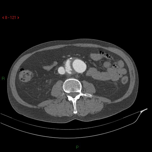 Abdominal aortic aneurysm rupture with aortocaval fistula (Radiopaedia 14897-14841 Axial C+ arterial phase 121).jpg