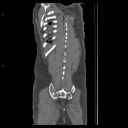 File:Abdominal aortic aneurysm rupture with aortocaval fistula (Radiopaedia 14897-14841 Coronal C+ arterial phase 38).jpg
