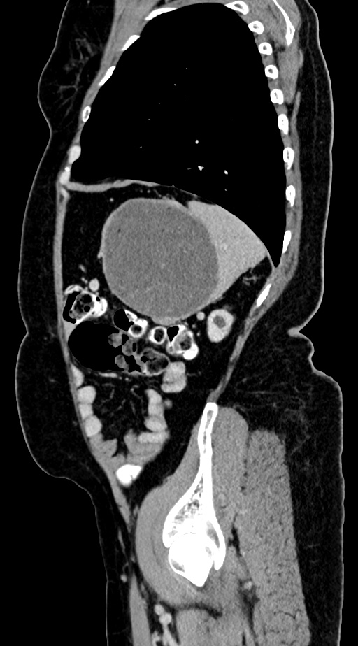 Abdominal hydatid disease (Radiopaedia 68223-77737 Sagittal C+ portal venous phase 15).jpg
