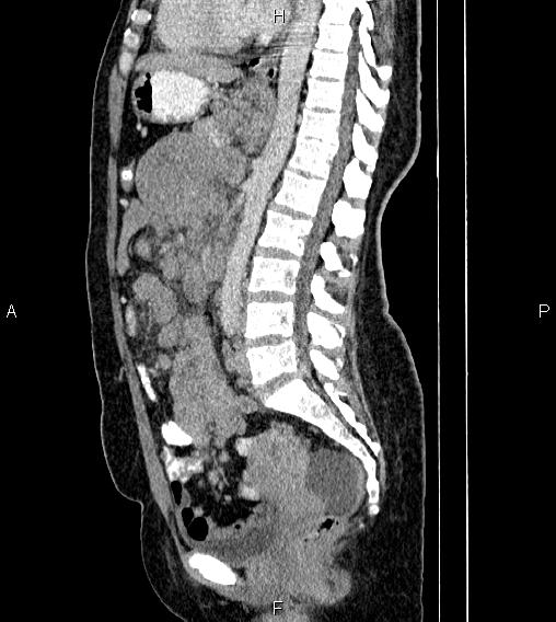 Abdominal lymphoma with sandwich sign (Radiopaedia 84378-99704 Sagittal C+ portal venous phase 48).jpg