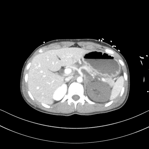File:Abdominal multi-trauma - devascularised kidney and liver, spleen and pancreatic lacerations (Radiopaedia 34984-36486 Axial C+ portal venous phase 22).png