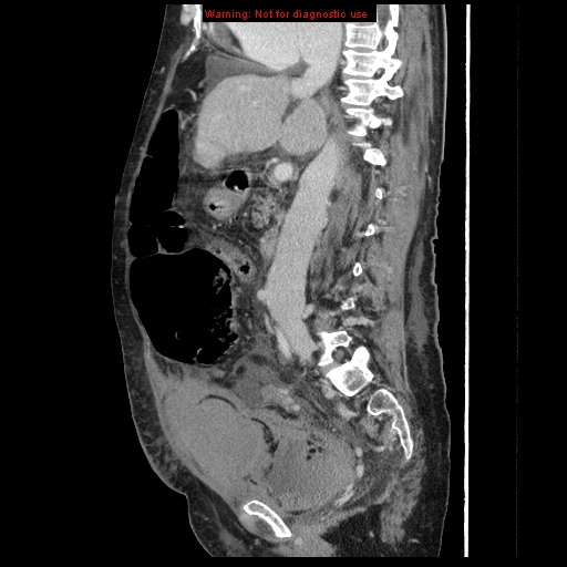 Abdominal wall hematoma (Radiopaedia 9427-10112 Sagittal C+ portal venous phase 59).jpg