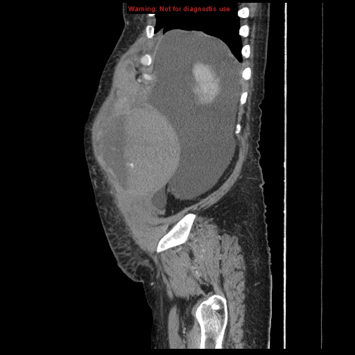 Abdominal wall hematoma (Radiopaedia 9427-10112 Sagittal C+ portal venous phase 92).jpg