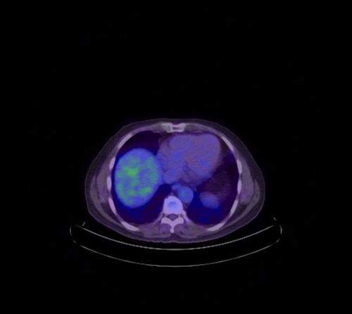 Abdominal wall metastasis from colorectal carcinoma (Radiopaedia 31016-31719 Axial 96).jpg