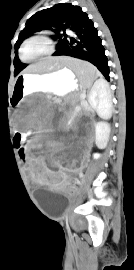 Abdominopelvic rhabdomyosarcoma (Radiopaedia 78356-90984 Sagittal C+ portal venous phase 33).jpg