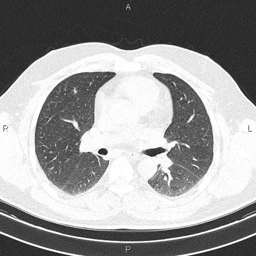 Aberrant right subclavian artery (Radiopaedia 87093-103354 Axial lung window 52).jpg