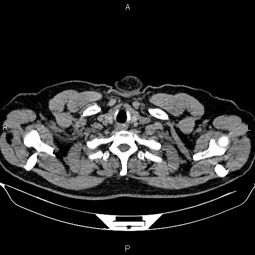 File:Aberrant right subclavian artery (Radiopaedia 87093-103354 Axial non-contrast 4).jpg