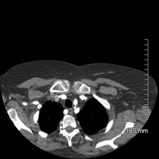 Aberrant right subclavian artery stenosis (Radiopaedia 52656-58670 Axial C+ arterial phase 14).jpg
