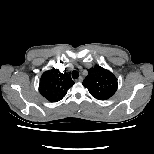 Accessory left horizontal fissure with lingular pneumonia (Radiopaedia 53763-59843 Axial C+ CTPA 18).jpg
