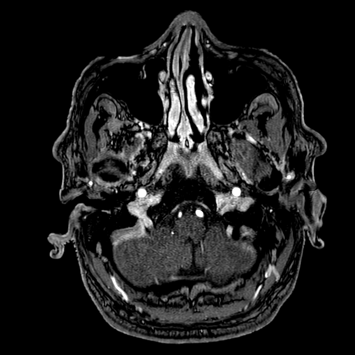 Accessory middle cerebral artery (Radiopaedia 73114-83828 Axial MRA 11).jpg