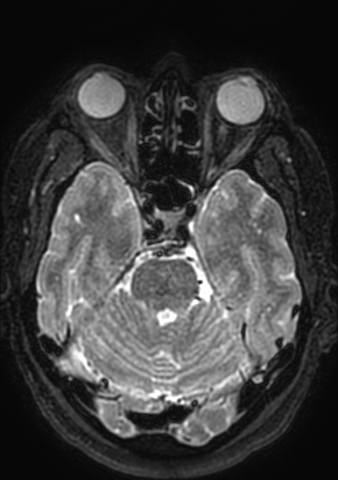 Accessory middle cerebral artery (Radiopaedia 73114-83828 Axial T2 140).jpg