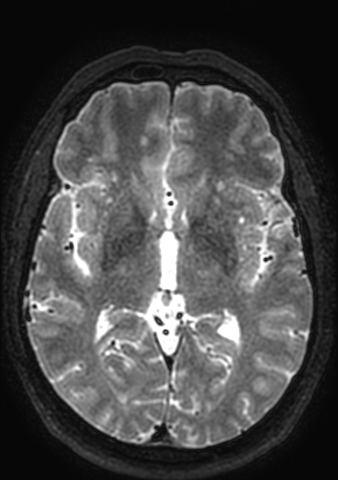 Accessory middle cerebral artery (Radiopaedia 73114-83828 Axial T2 77).jpg