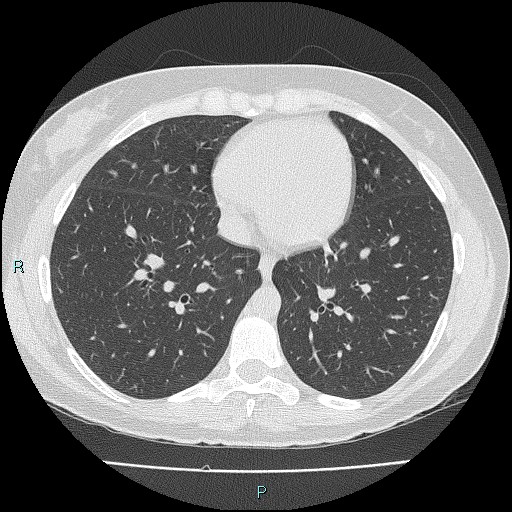 File:Accidental foreign body aspiration (seamstress needle) (Radiopaedia 77740-89983 Axial lung window 44).jpg