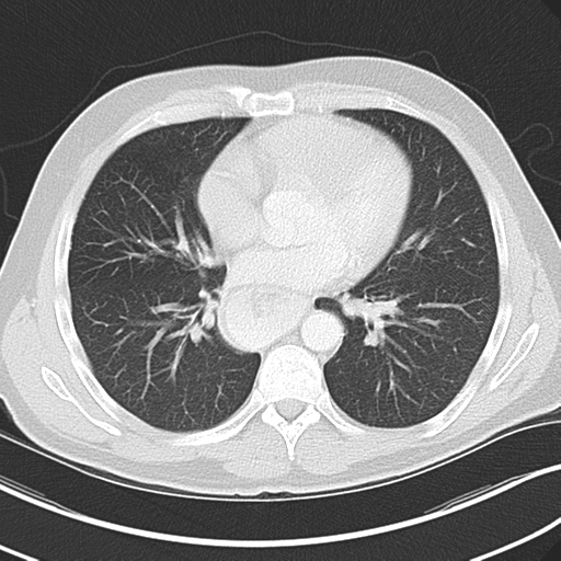 Achalasia of the cardia (Radiopaedia 38497-40595 Axial lung window 31).png